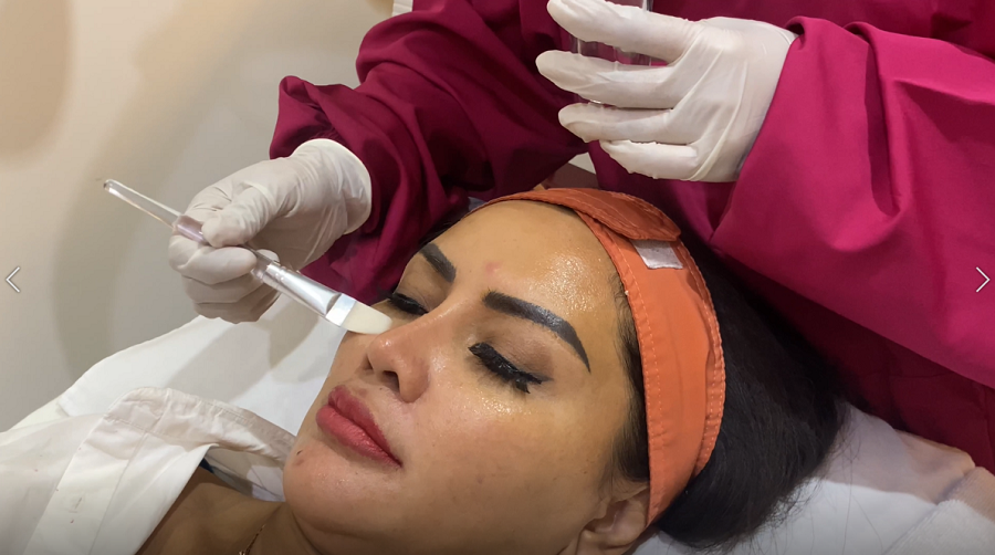 Chemical Peel